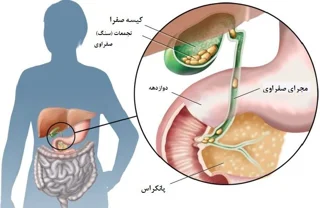 دمنوش ها و دیگر خوراکی های مناسب برای پس از عمل جراحی صفرا